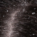 DANDRUFF